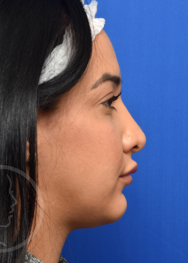 Rhinoplasty Before and After Pictures Jacksonville, FL