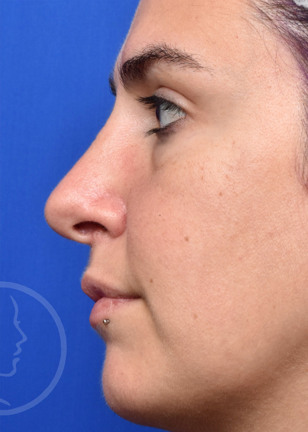 Rhinoplasty Before and After Pictures Jacksonville, FL