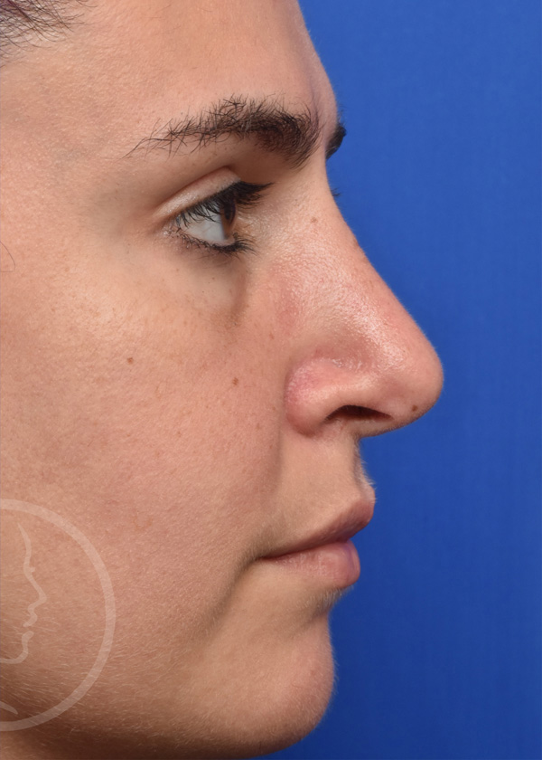 Rhinoplasty Before and After Pictures Jacksonville, FL