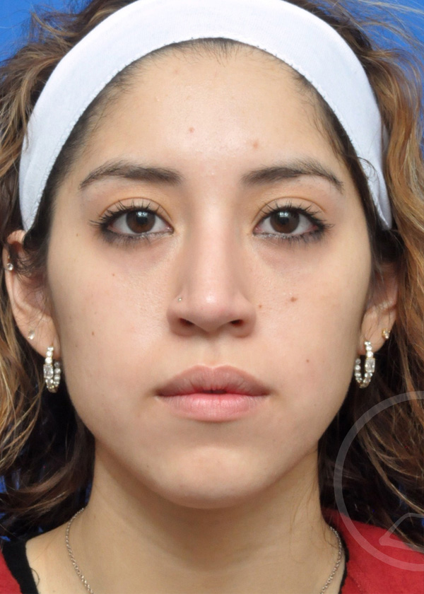 Rhinoplasty Before and After Pictures Jacksonville, FL