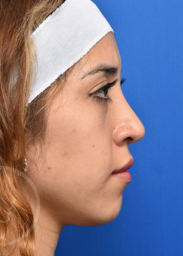 Rhinoplasty Before and After Pictures Jacksonville, FL