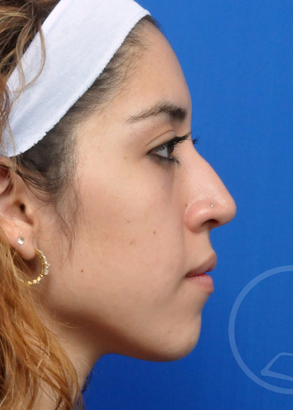 Rhinoplasty Before and After Pictures Jacksonville, FL