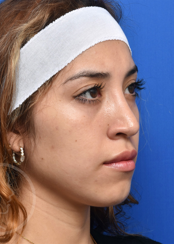 Rhinoplasty Before and After Pictures Jacksonville, FL