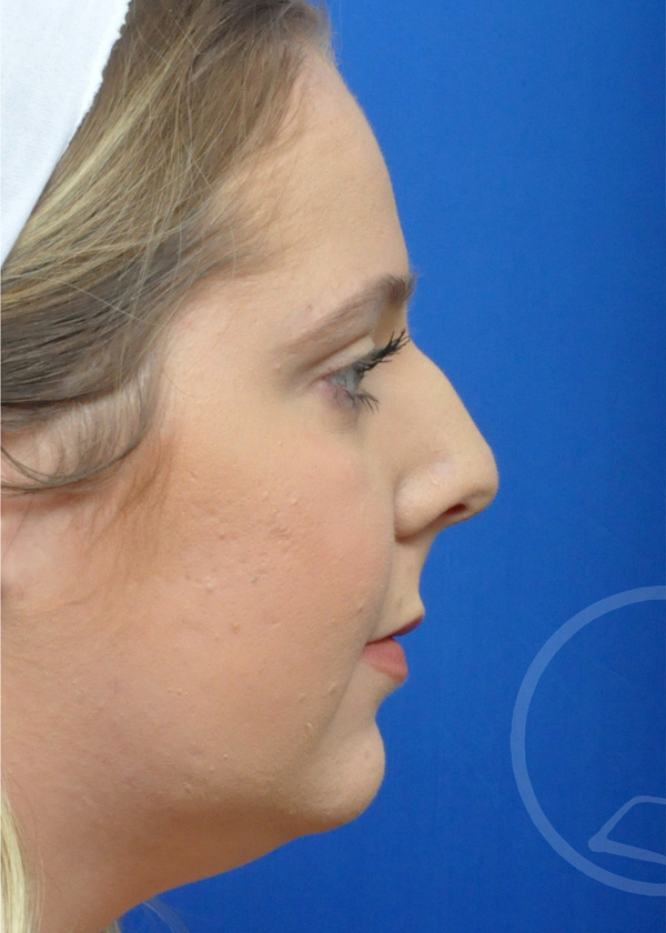 Rhinoplasty Before and After Pictures Jacksonville, FL