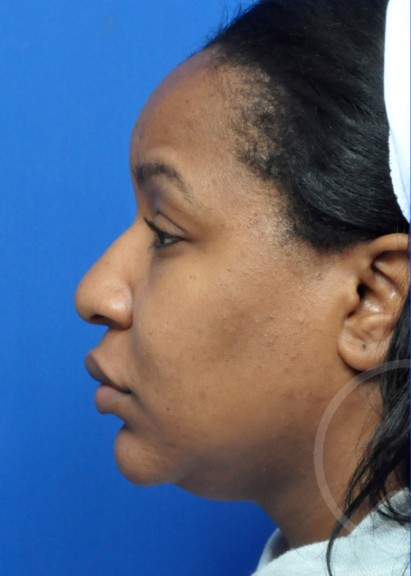 Rhinoplasty Before and After Pictures Jacksonville, FL