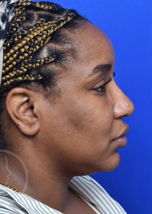 Rhinoplasty Before and After Pictures Jacksonville, FL