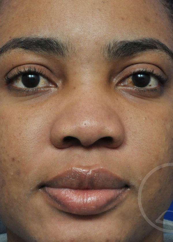 Rhinoplasty Before and After Pictures Jacksonville, FL