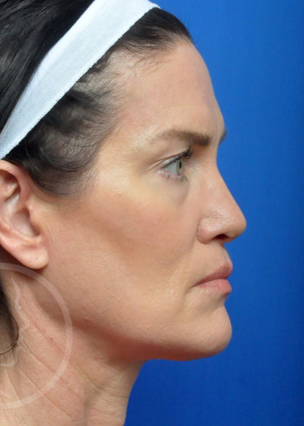 Rhinoplasty Before and After Pictures Jacksonville, FL