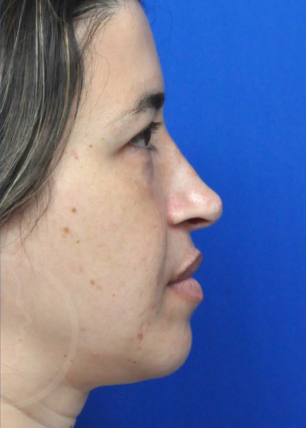 Rhinoplasty Before and After Pictures Jacksonville, FL