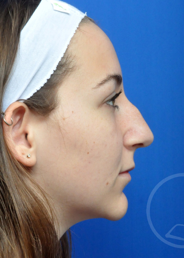 Rhinoplasty Before and After Pictures Jacksonville, FL