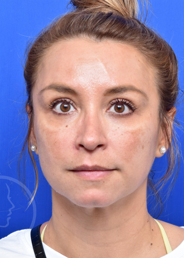 Rhinoplasty Before and After Pictures Jacksonville, FL