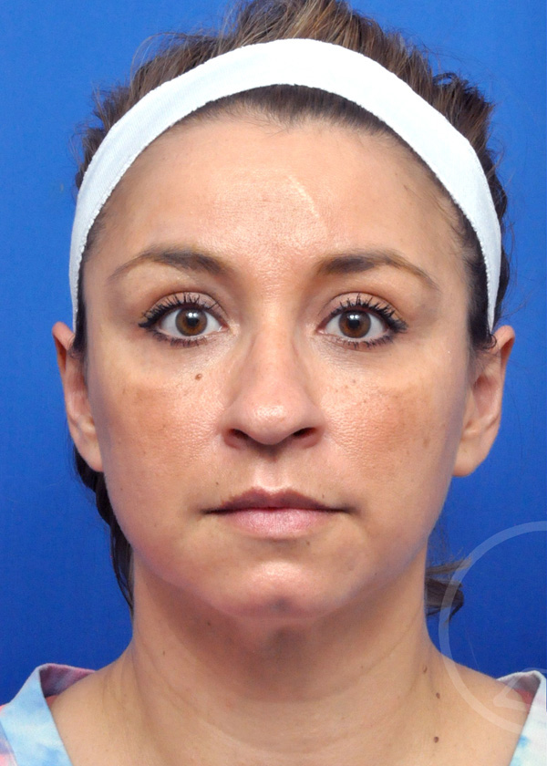 Rhinoplasty Before and After Pictures Jacksonville, FL