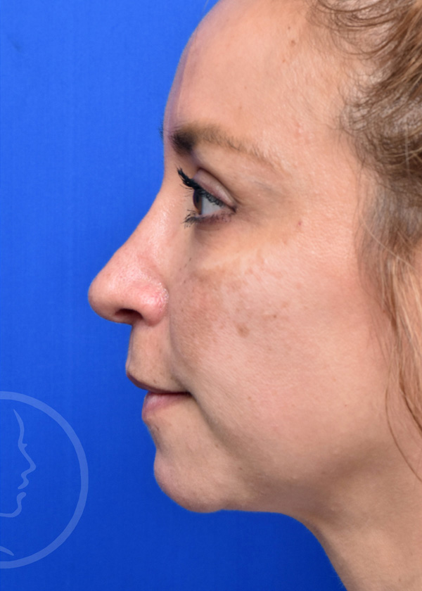 Rhinoplasty Before and After Pictures Jacksonville, FL