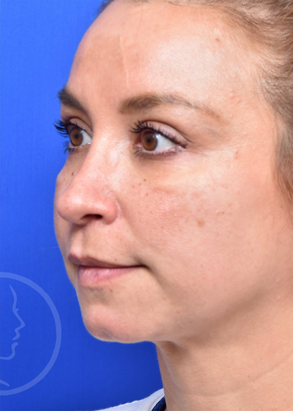 Rhinoplasty Before and After Pictures Jacksonville, FL