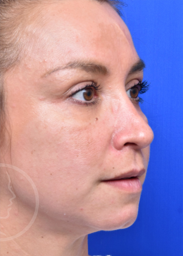 Rhinoplasty Before and After Pictures Jacksonville, FL