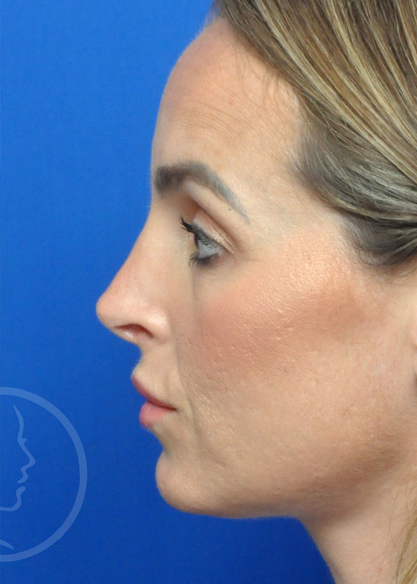 Rhinoplasty Before and After Pictures Jacksonville, FL