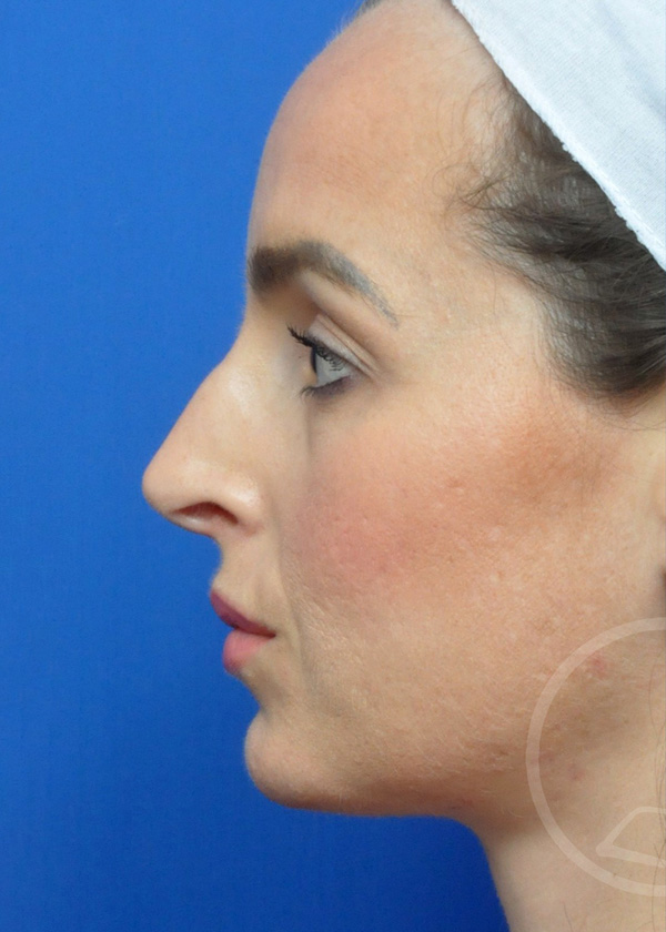 Rhinoplasty Before and After Pictures Jacksonville, FL