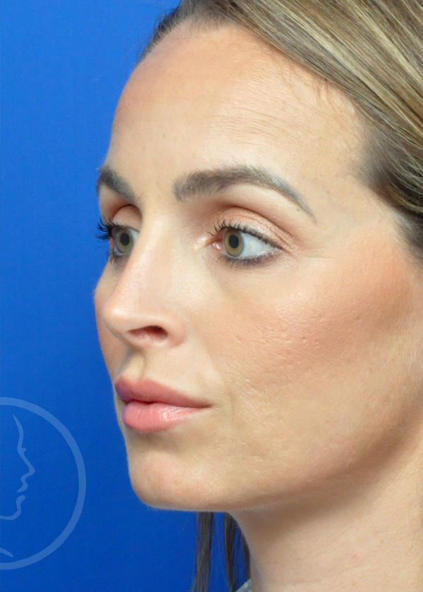 Rhinoplasty Before and After Pictures Jacksonville, FL