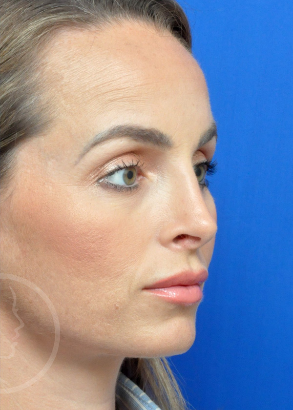 Rhinoplasty Before and After Pictures Jacksonville, FL