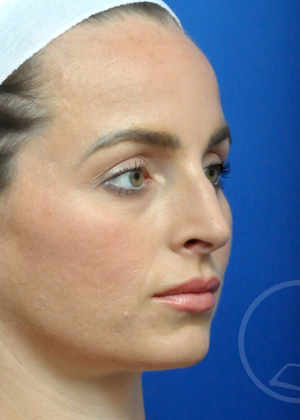 Rhinoplasty Before and After Pictures Jacksonville, FL