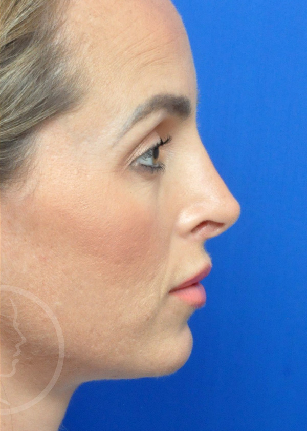 Rhinoplasty Before and After Pictures Jacksonville, FL