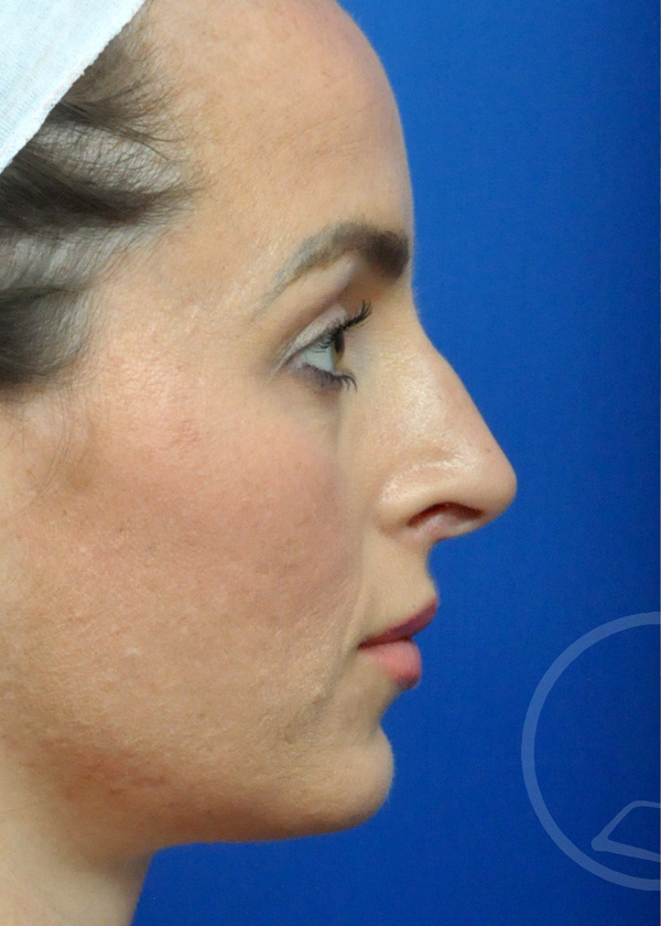 Rhinoplasty Before and After Pictures Jacksonville, FL