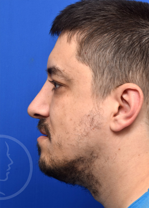 Rhinoplasty Before and After Pictures Jacksonville, FL