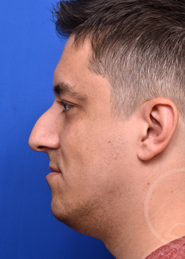 Rhinoplasty Before and After Pictures Jacksonville, FL