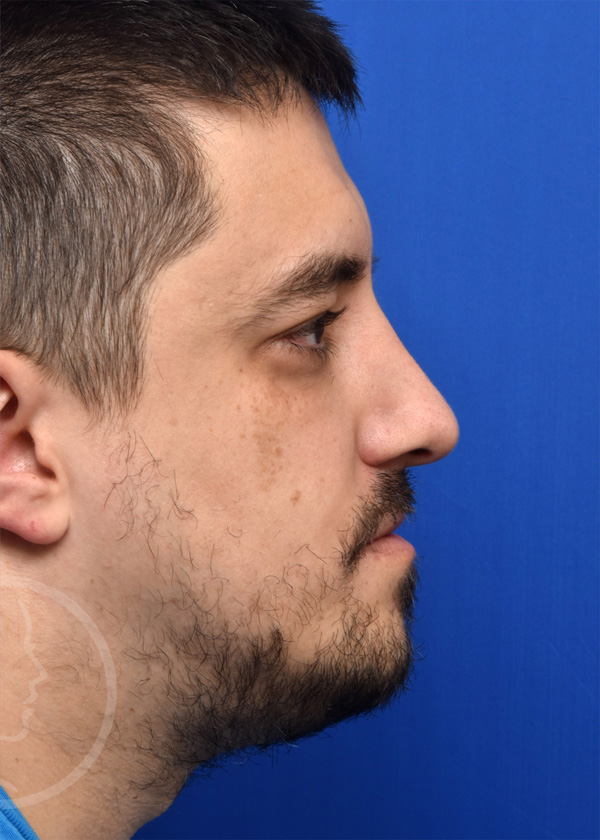 Rhinoplasty Before and After Pictures Jacksonville, FL