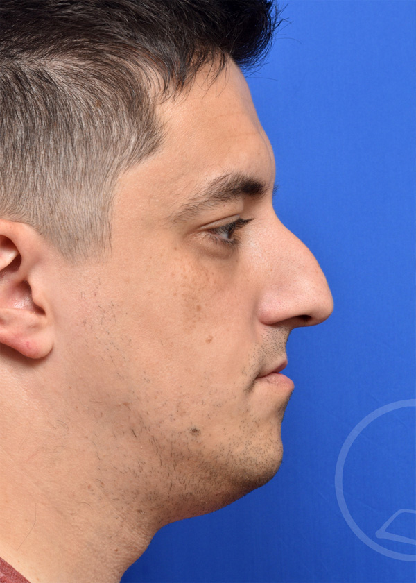 Rhinoplasty Before and After Pictures Jacksonville, FL