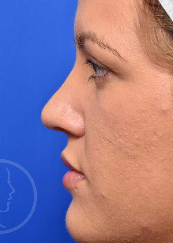 Rhinoplasty Before and After Pictures Jacksonville, FL