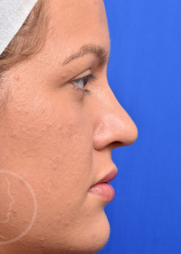 Rhinoplasty Before and After Pictures Jacksonville, FL