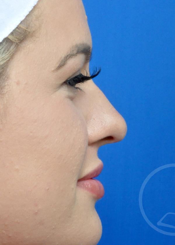 Rhinoplasty Before and After Pictures Jacksonville, FL