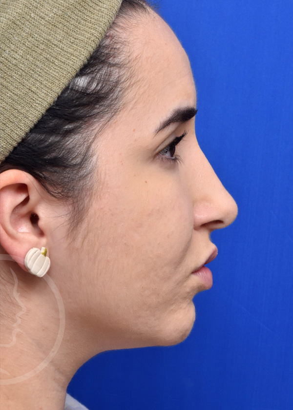 Rhinoplasty Before and After Pictures Jacksonville, FL