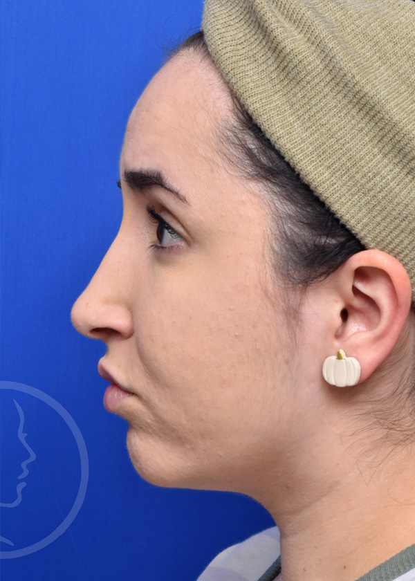 Rhinoplasty Before and After Pictures Jacksonville, FL