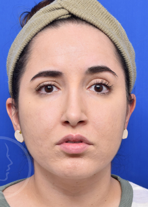 Rhinoplasty Before and After Pictures Jacksonville, FL