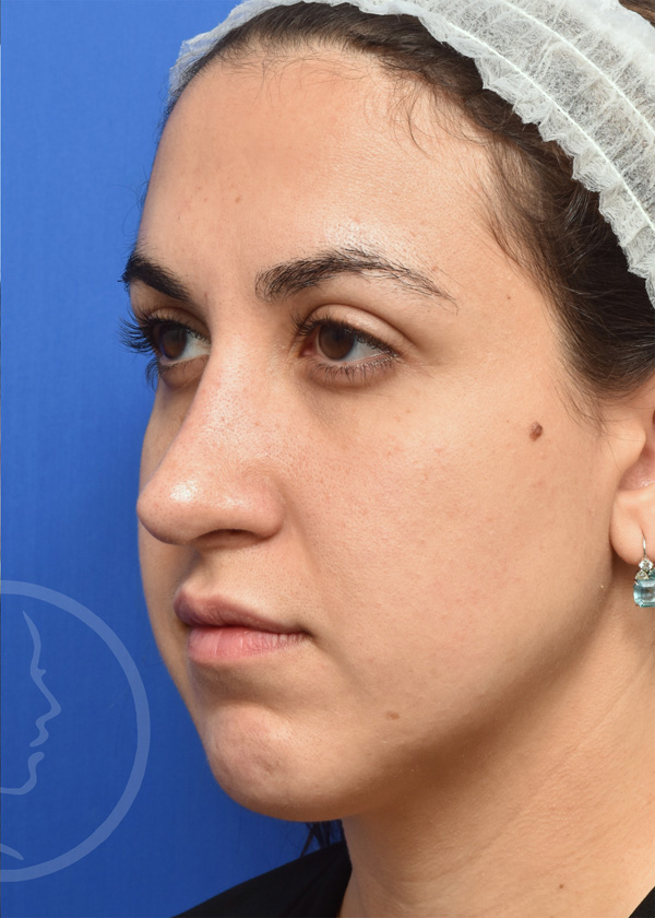 Rhinoplasty Before and After Pictures Jacksonville, FL