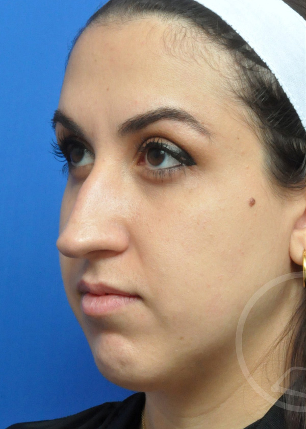 Rhinoplasty Before and After Pictures Jacksonville, FL