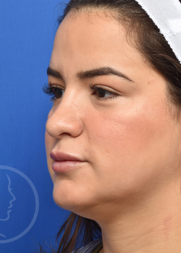 Rhinoplasty Before and After Pictures Jacksonville, FL