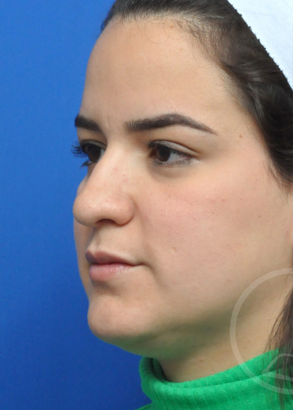 Rhinoplasty Before and After Pictures Jacksonville, FL