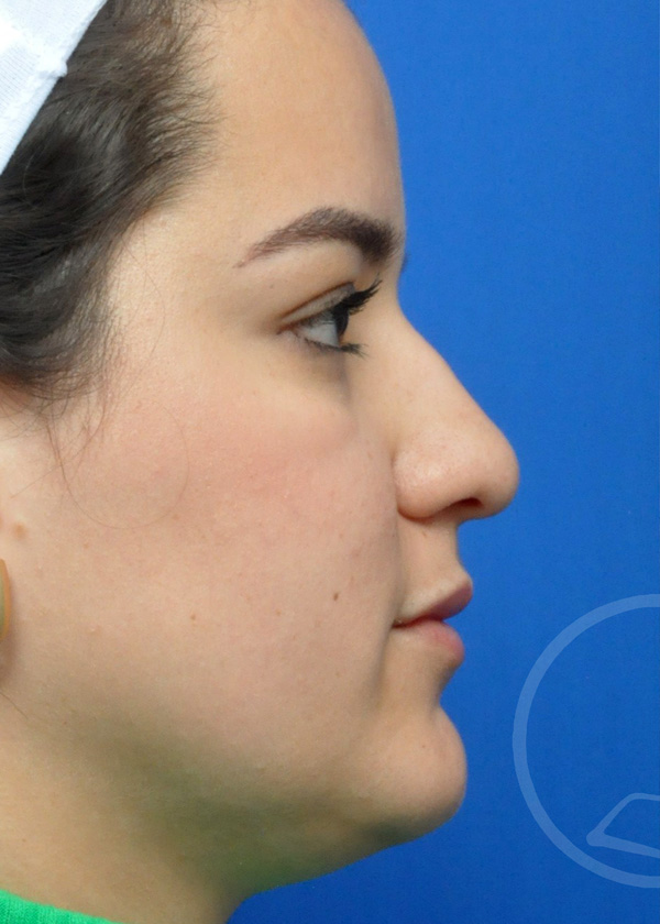 Rhinoplasty Before and After Pictures Jacksonville, FL