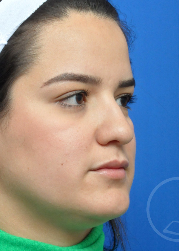 Rhinoplasty Before and After Pictures Jacksonville, FL