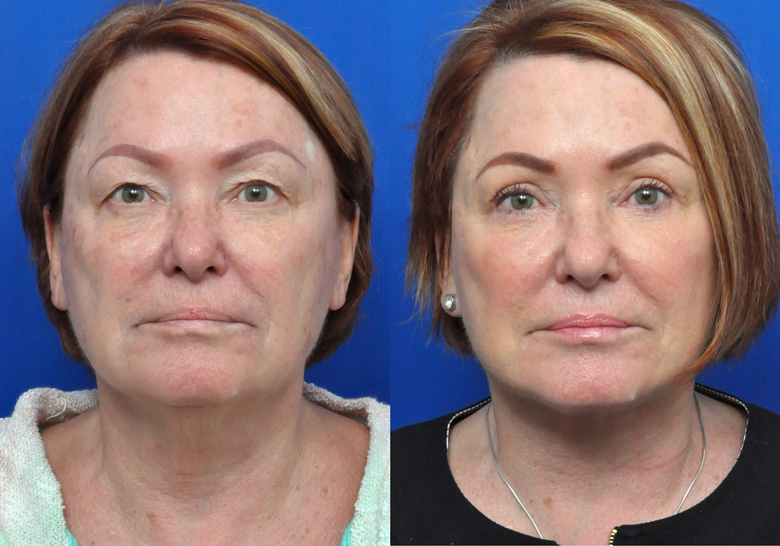 Facelift Journeys - Garcia Facial Plastic Surgery