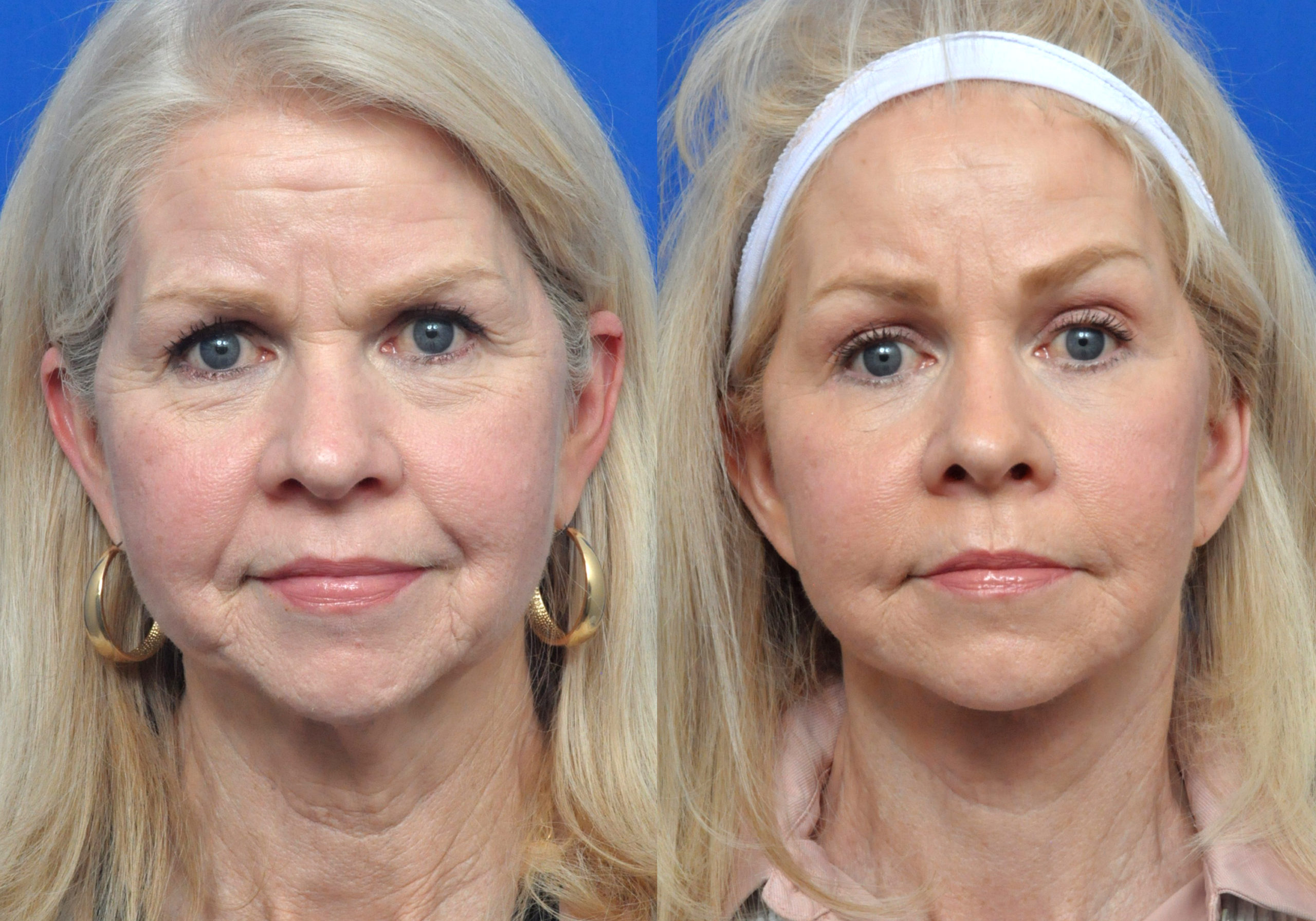 Facelift Journeys - Garcia Facial Plastic Surgery