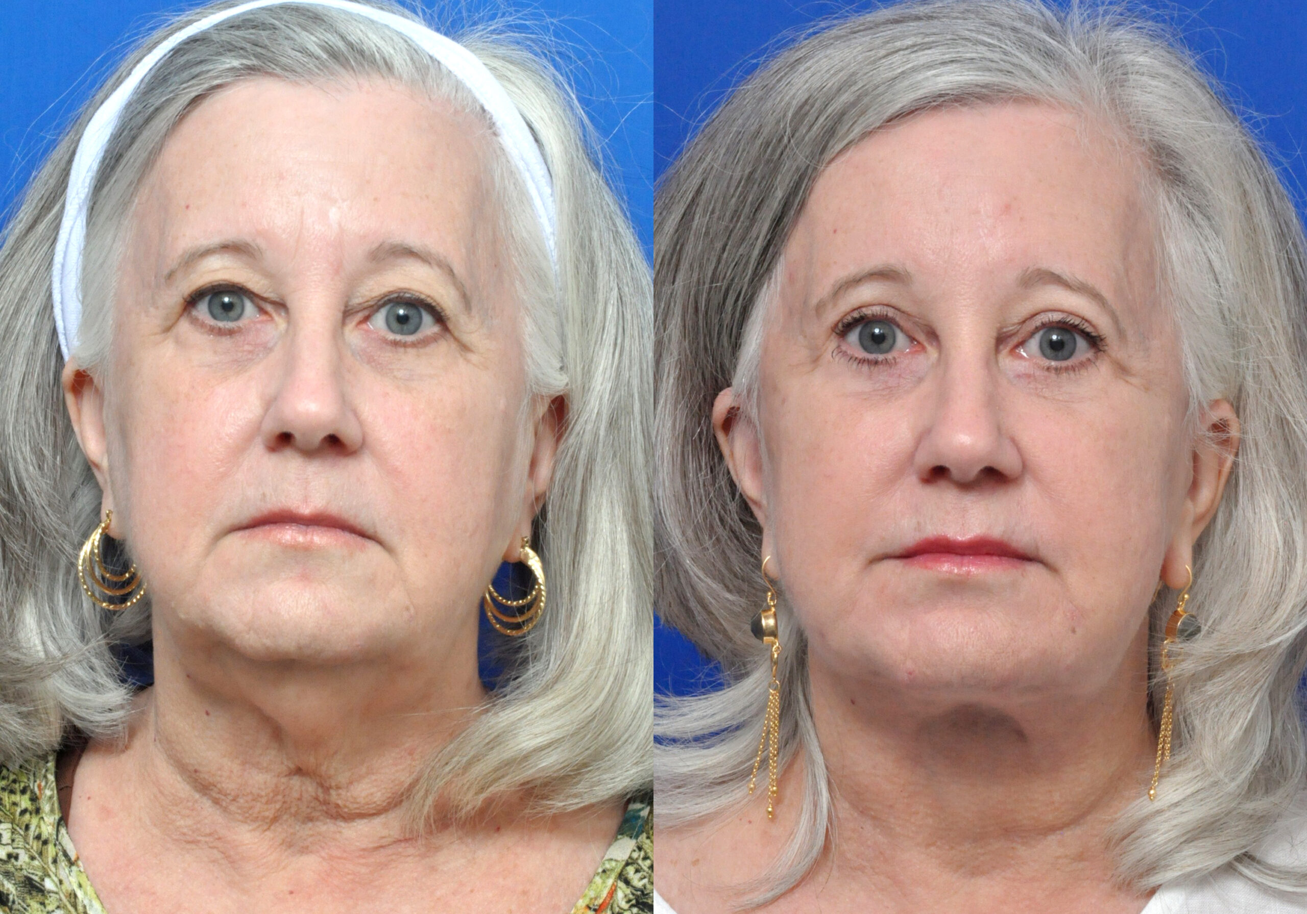Brow Lift Journeys - Garcia Facial Plastic Surgery