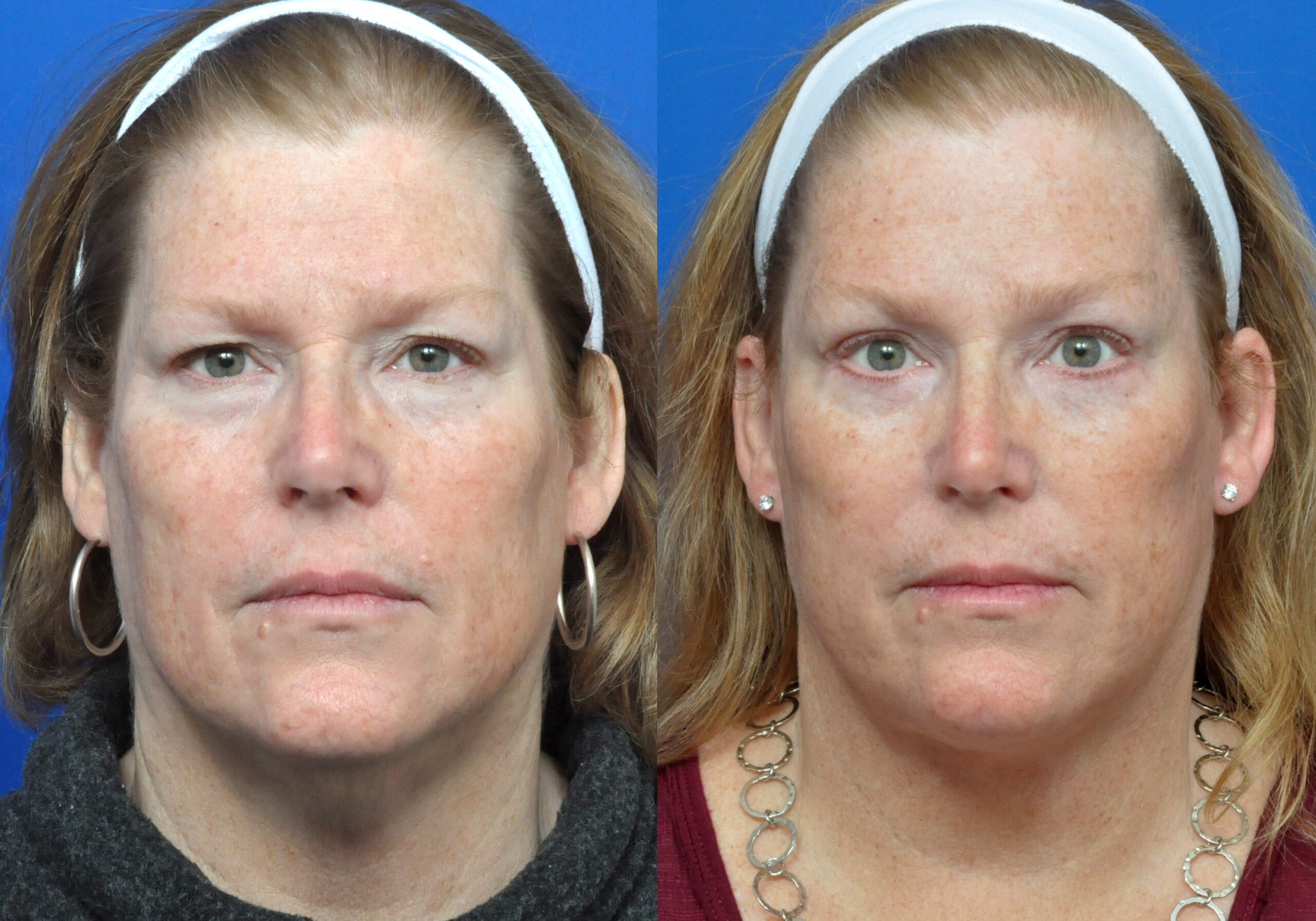 Brow Lift Journeys - Garcia Facial Plastic Surgery