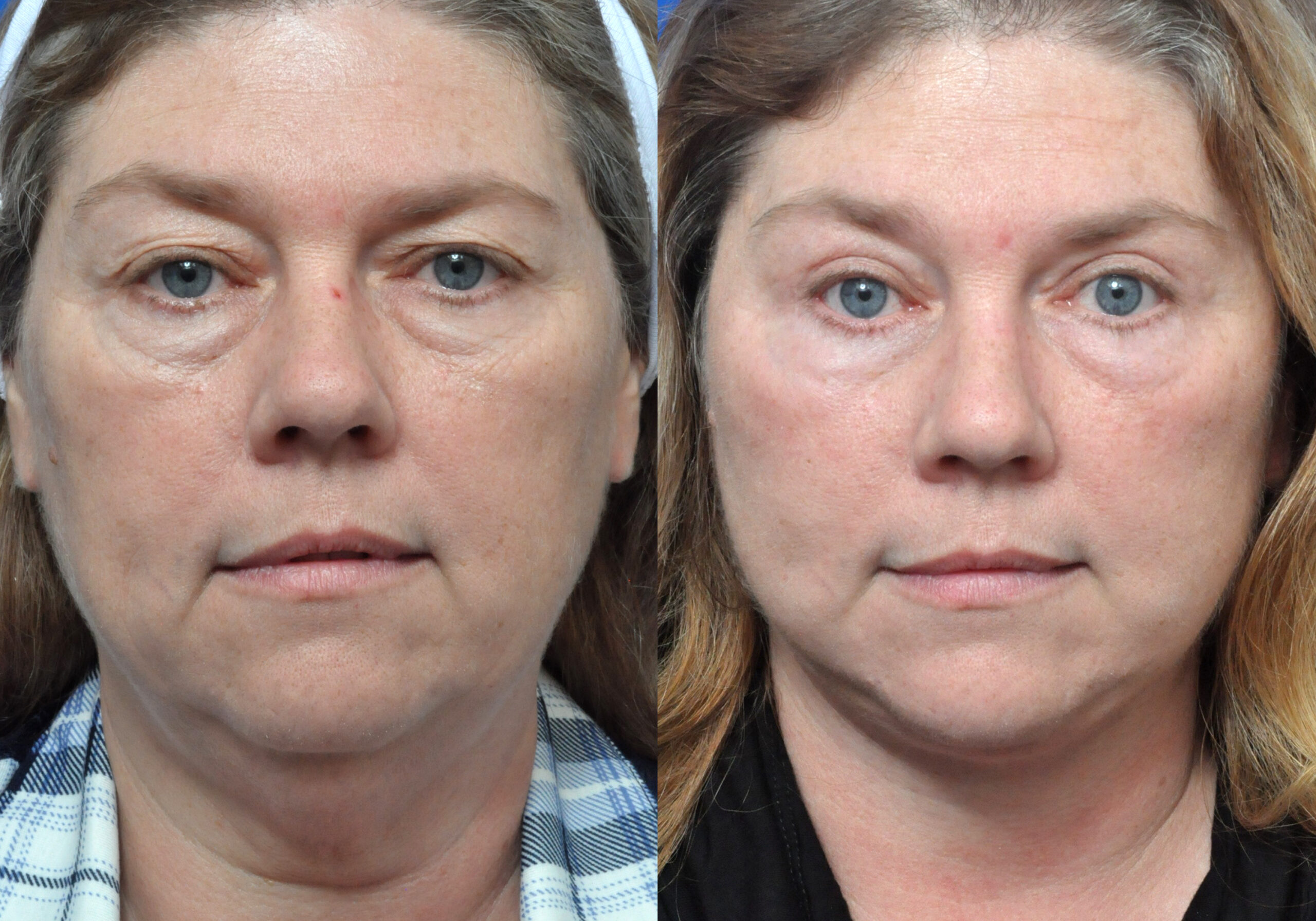 Brow Lift Journeys - Garcia Facial Plastic Surgery