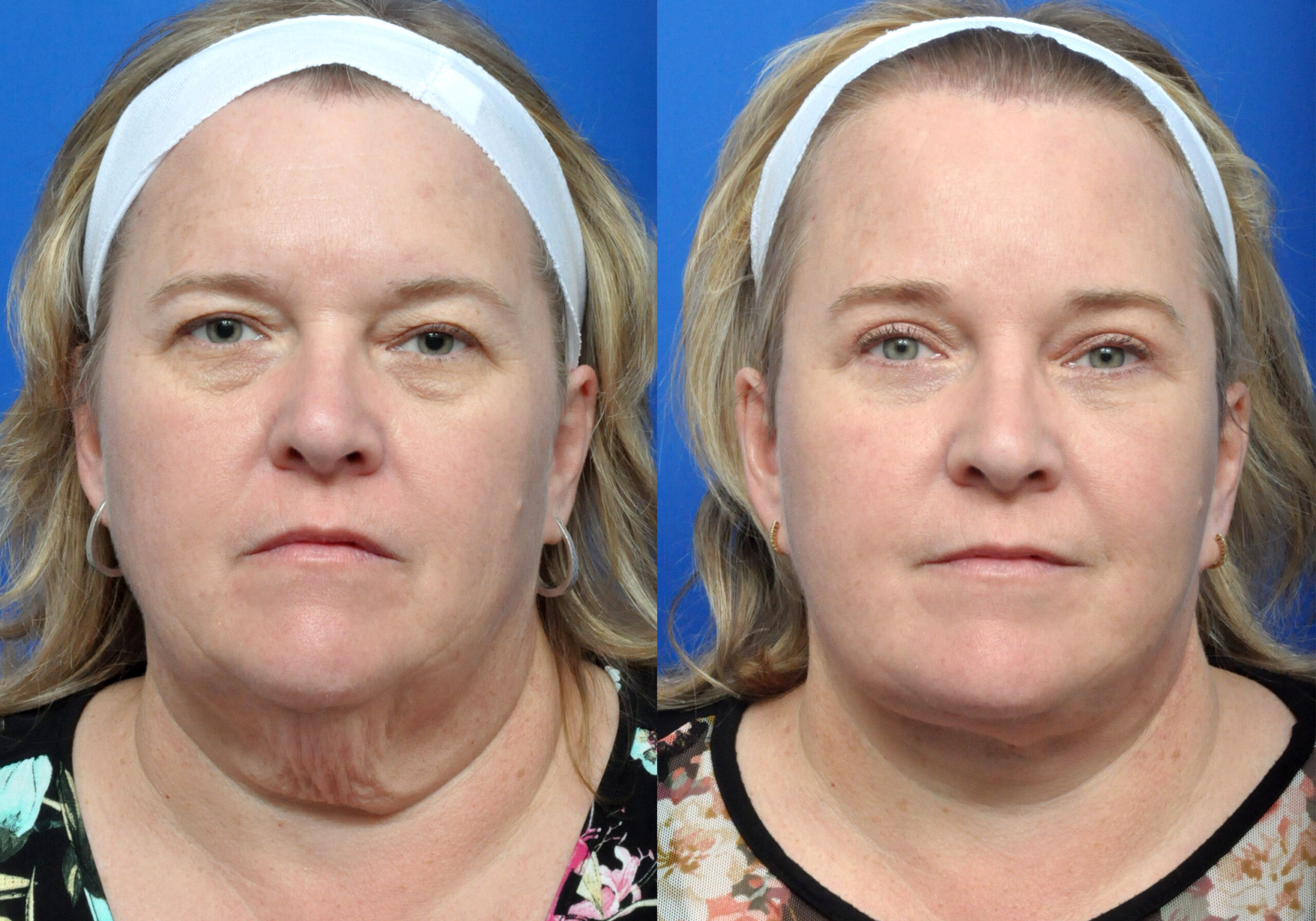 Brow Lift Journeys - Garcia Facial Plastic Surgery