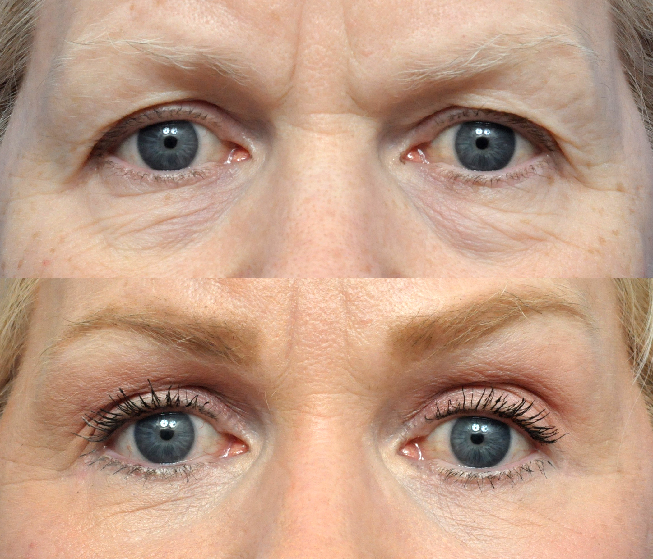 Brow Lift in Jacksonville, FL
