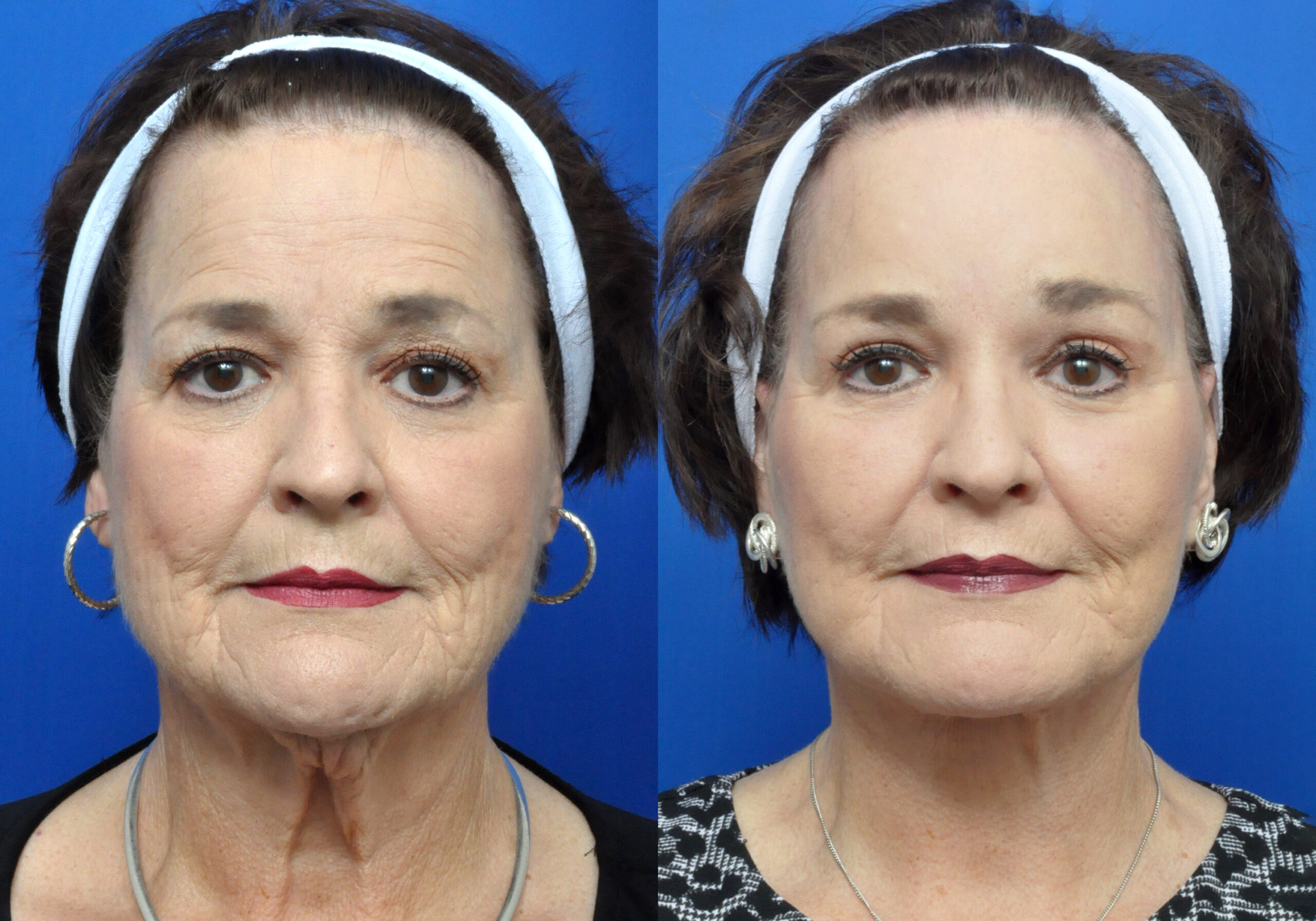 Brow Lift Journeys - Garcia Facial Plastic Surgery